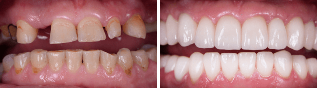 Before after veneers 1