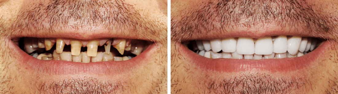 Before after veneers 2