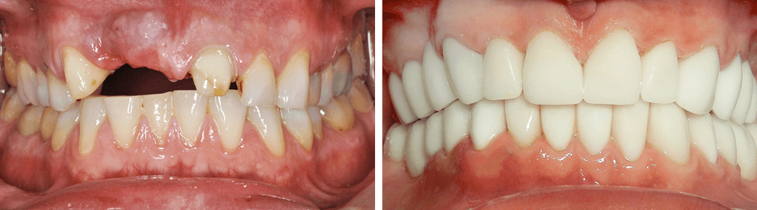 Before after veneers 1