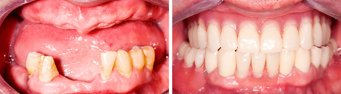 Before after veneers 3